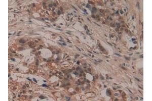 DAB staining on IHC-P; Samples: Human Pancreatic cancer Tissue (LIFR anticorps  (AA 45-184))