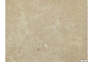 IHC-P Image MMP19 antibody detects MMP19 protein at cytosol on human hepatoma by immunohistochemical analysis.