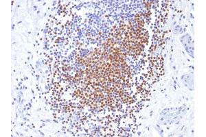 Formalin-fixed, paraffin-embedded human Urothelial Carcinoma stained with PAX8 Mouse Monoclonal Antibody (PAX8/1492).