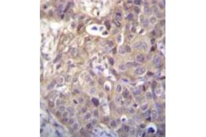 Immunohistochemistry analysis in formalin fixed and paraffin embedded human breast carcinoma recated with HIPK1 Antibody (C-term) followed by peroxidase conjugation of the secondary antibody and DAB staining. (HIPK1 anticorps  (C-Term))