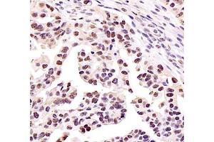 Immunohistochemistry of paraffin embedded human ovarian cancer using ZKSCAN4 (ABIN7076265) at dilution of 1:400 (400x lens)
