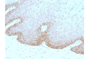 IHC testing of human cervical carcinoma with FAT2 antibody (clone 8C5). (FAT Atypical Cadherin 2 (FAT2) anticorps)