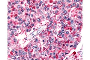 Anti-BAI2 antibody IHC of human Lung, Non-Small Cell Carcinoma. (BAI2 anticorps  (N-Term))