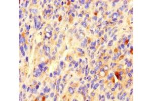 Immunohistochemistry of paraffin-embedded human melanoma using ABIN7148160 at dilution of 1:100 (CCDC84 anticorps  (AA 1-200))