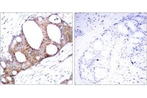 Immunohistochemistry analysis of paraffin-embedded human breast carcinoma, using GSK3 alpha (Phospho-Ser21) Antibody. (GSK3 alpha anticorps  (AA 10-59))