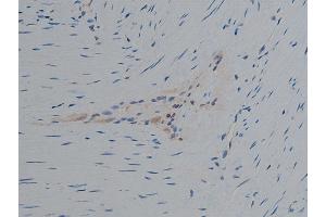ABIN6267420 at 1/50 staining human colon carcinoma tissue sections by IHC-P.