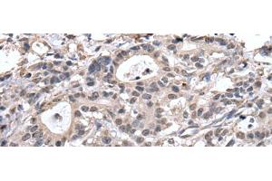 Immunohistochemistry of paraffin-embedded Human gastric cancer tissue using TRIM27 Polyclonal Antibody at dilution of 1:65(x200) (TRIM27 anticorps)