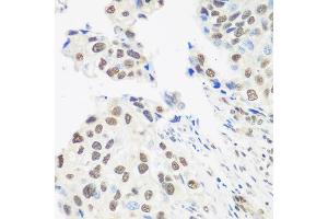 Immunohistochemistry of paraffin-embedded human prostate cancer using DDX39B antibody. (DDX39B anticorps)