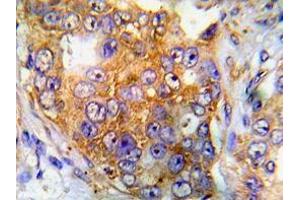 Immunohistochemistry analyzes of 4E-BP1 antibody in paraffin-embedded human breast carcinoma tissue. (eIF4EBP1 anticorps)