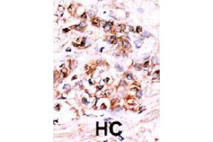 Formalin-fixed and paraffin-embedded human hepatocellular carcinoma tissue reacted with DUSP15 polyclonal antibody  , which was peroxidase-conjugated to the secondary antibody, followed by AEC staining. (DUSP15 anticorps  (N-Term))
