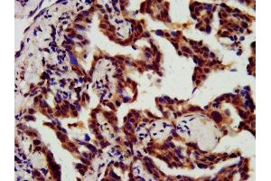 IHC image of ABIN7147529 diluted at 1:800 and staining in paraffin-embedded human lung cancer performed on a Leica BondTM system. (CHMP5 anticorps  (AA 1-219))
