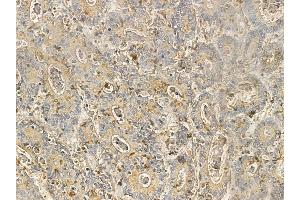 ZBTB7C Mouse Monoclonal Antibody at 1/100 staining human colorectal cancer by IHC-P. (ZBTB7C anticorps)