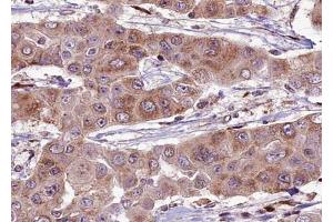 ABIN6274061 at 1/100 staining human liver carcinoma tissue sections by IHC-P.