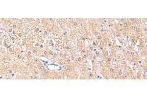 Immunohistochemistry of paraffin-embedded Human liver cancer tissue using MLKL Polyclonal Antibody at dilution of 1:85(x200)