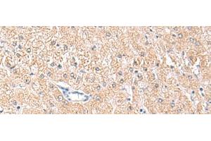 Immunohistochemistry of paraffin-embedded Human liver cancer tissue using MLKL Polyclonal Antibody at dilution of 1:85(x200) (MLKL anticorps)
