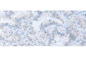 Immunohistochemistry of paraffin-embedded Human lung cancer tissue using ATP6V1C1 Polyclonal Antibody at dilution of 1:100(x200)
