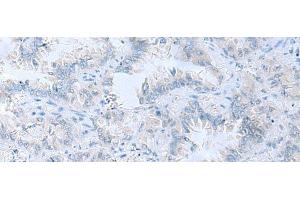 Immunohistochemistry of paraffin-embedded Human lung cancer tissue using ATP6V1C1 Polyclonal Antibody at dilution of 1:100(x200) (ATP6V1C1 anticorps)