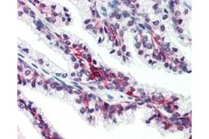 Immunohistochemistry (Formalin/PFA-fixed paraffin-embedded sections) of human prostate with SLC39A6 polyclonal antibody . (SLC39A6 anticorps  (Internal Region))