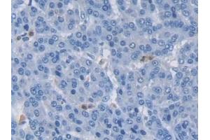 Detection of MIB2 in Human Liver cancer Tissue using Polyclonal Antibody to Mindbomb Homolog 2 (MIB2)