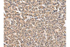 The image on the left is immunohistochemistry of paraffin-embedded Human liver cancer tissue using ABIN7131587(VPS41 Antibody) at dilution 1/20, on the right is treated with fusion protein. (VPS41 anticorps)