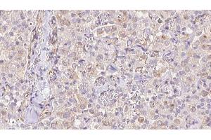 ABIN6273331 at 1/100 staining Human thyroid cancer tissue by IHC-P. (TIMM9 anticorps  (C-Term))