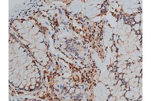ABIN6267444 at 1/50 staining human colon cancer tissue sections by IHC-P.