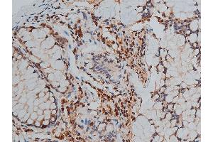 ABIN6267444 at 1/50 staining human colon cancer tissue sections by IHC-P. (GATA3 anticorps  (pSer308))