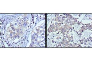 Immunohistochemical analysis of paraffin-embedded human lung cancer (left) and breast cancer (right) using RTN3 antibody with DAB staining.