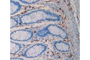 IHC-P analysis of Human Rectum Cancer Tissue, with DAB staining. (TPSAB1 anticorps  (AA 161-262))
