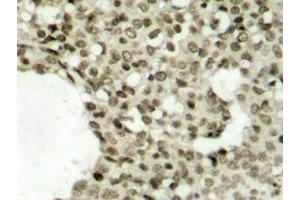 Immunohistochemistry of paraffin-embedded Human breast carcinoma tissue, using Phospho-STAT1(S727) Polyclonal Antibody