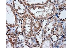 Immunohistochemical staining of paraffin-embedded Adenocarcinoma of ovary tissue using anti-LIPG mouse monoclonal antibody. (LIPG anticorps)