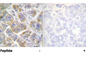 Immunohistochemical analysis of paraffin-embedded human breast carcinoma tissue using ITGB4 polyclonal antibody . (Integrin beta 4 anticorps)