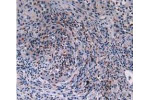 IHC-P analysis of Human Lung Cancer Tissue, with DAB staining. (MAT2A anticorps  (AA 176-395))