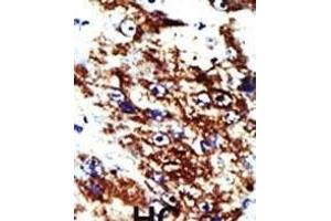Formalin-fixed and paraffin-embedded human cancer tissue reacted with the primary antibody, which was peroxidase-conjugated to the secondary antibody, followed by DAB staining.