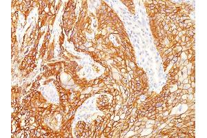 Formalin-fixed, paraffin-embedded human Lung SqCC stained with EGFR Mouse Monoclonal Antibody (GFR/2341). (EGFR anticorps  (AA 344-492))