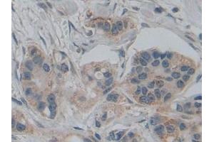 Detection of SMAD5 in Human Breast cancer Tissue using Polyclonal Antibody to SMAD family member 5 (SMAD5)