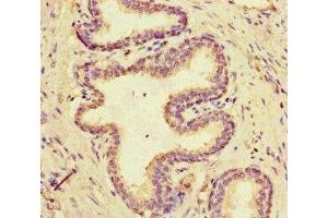 Immunohistochemistry of paraffin-embedded human prostate cancer using ABIN7160306 at dilution of 1:100