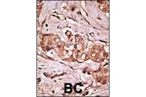 Formalin-fixed and paraffin-embedded human cancer tissue reacted with the primary antibody, which was peroxidase-conjugated to the secondary antibody, followed by AEC staining.