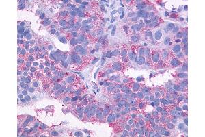 Anti-SIPR3 / EDG3 / S1P3 antibody IHC of human Ovary, Carcinoma. (S1PR3 anticorps  (C-Term))