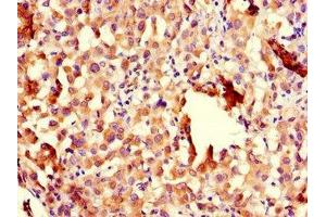Immunohistochemistry of paraffin-embedded human lung cancer using ABIN7151005 at dilution of 1:100 (CHFR anticorps  (AA 141-422))
