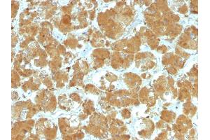 Formalin-fixed, paraffin-embedded human Thyroid Carcinoma stained with TSHRA Mouse Monoclonal Antibody (TSHRA/1402). (TSH receptor anticorps)