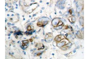 IHC-P: IP10 antibody testing of human breast cancer tissue