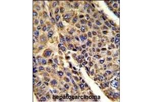 Formalin-fixed and paraffin-embedded human hepatocarcinoma reacted with VDAC1 Antibody (N-term), which was peroxidase-conjugated to the secondary antibody, followed by DAB staining.