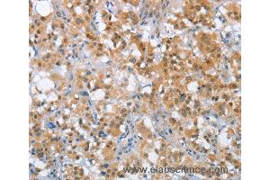 Immunohistochemistry of Human thyroid cancer using MLH1 Polyclonal Antibody at dilution of 1:65 (MLH1 anticorps)
