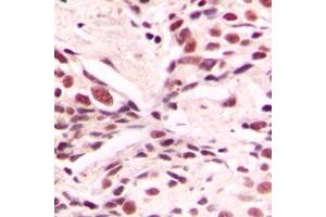 Immunohistochemical analysis of LMX1B staining in human breast cancer formalin fixed paraffin embedded tissue section. (LMX1B anticorps  (Center))
