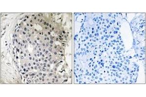 Immunohistochemistry analysis of paraffin-embedded human breast carcinoma tissue, using ARHGEF10 Antibody. (ARHGEF10 anticorps  (AA 339-388))