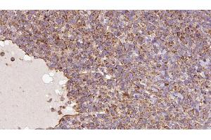 ABIN6273182 at 1/100 staining Human lymph cancer tissue by IHC-P. (UQCRC1 anticorps  (C-Term))