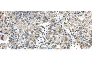 Immunohistochemistry of paraffin-embedded Human breast cancer tissue using FUS Polyclonal Antibody at dilution 1:45 (FUS anticorps)