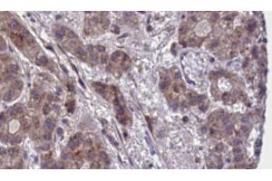 ABIN6273882 at 1/100 staining Human liver cancer tissue by IHC-P. (GPR55 anticorps  (Internal Region))