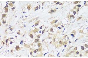 Immunohistochemistry of paraffin-embedded Human breast cancer using ASCL4 Polyclonal Antibody at dilution of 1:100 (40x lens). (ASCL4 anticorps)